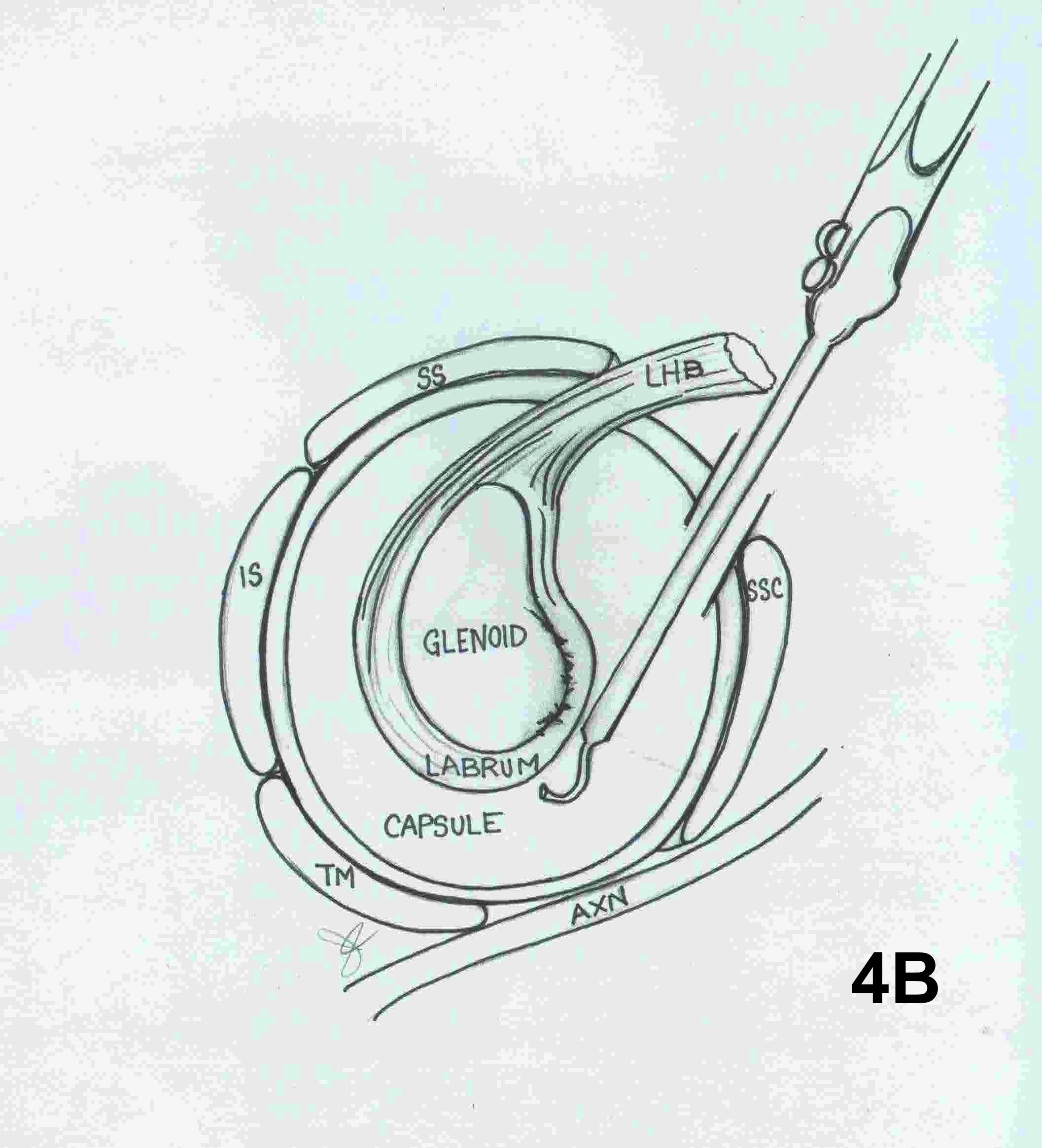 Labral Repair